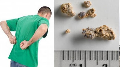 Cara mengatasi sakit pinggang karena batu ginjal