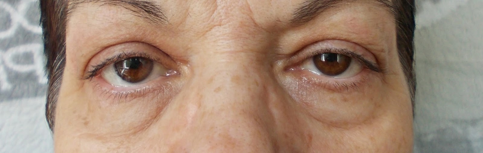 despre riduri si cearcane operația de îndepărtare a ridurilor de sub ochi