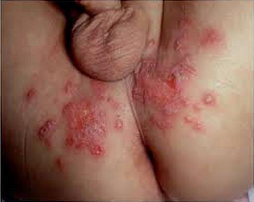 MALE GENITAL HERPES Pictures Photos - Doctor Online