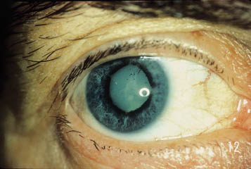 Gejala dan Penyebab Penyakit Mata Katarak