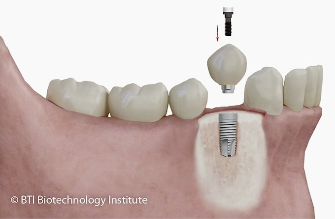 IMPLANTODONTIA: Estudo revela tendência em substituir dentes saudáveis por implantes