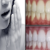 Eliminate Bad Breath (HALITOSIS) Permanently and Whiten Your Teeth Fast With Easy Home Remedies