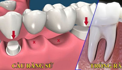 Sự khác nhau giữa cấy ghép implant và bọc răng sứ