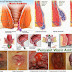 Menyembuhkan Wasir atau Ambeien (Hemoroid) thumbnail