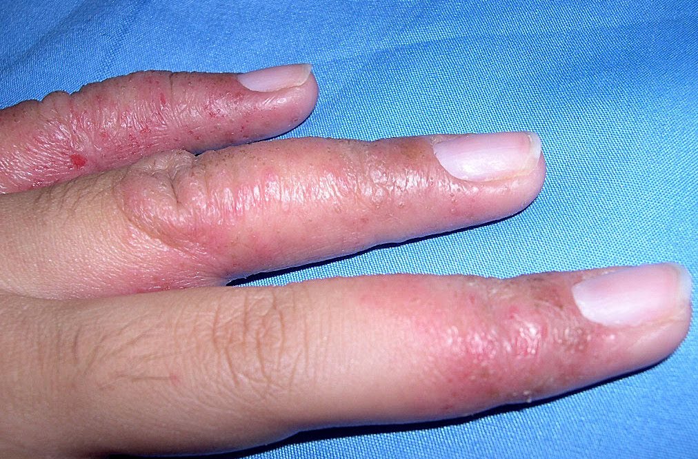 Dyshidrotic Eczema - Pictures, Treatment, Causes ...