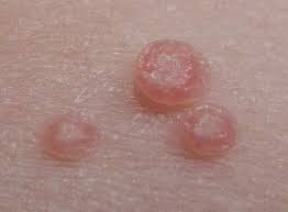 Qué-es-el-molusco-contagioso