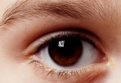 What Causes Dry Eyes
