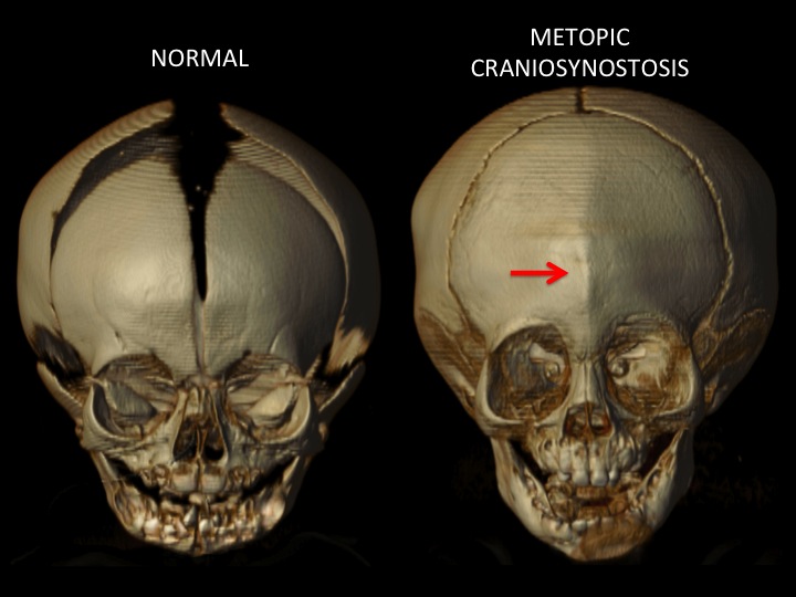 The Adventures of Metopic Benjamin!: What is Metopic Craniosynostosis?