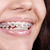 Niềng răng kim loại là gì?