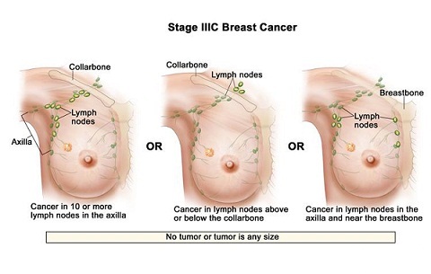 Apologise, Iv inflammatory breast cancer consider, that Not Iv inflammatory breast cancer good when