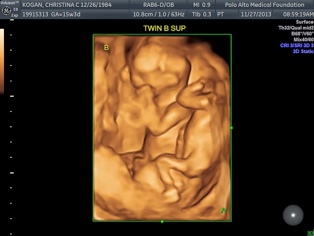 Kogan Twins: 15 week ultrasound
