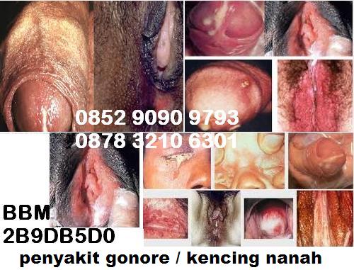Cara Mengatasi Gonorrhea (Kelamin Keluar Nanah) Cara Mengatasi Gonorrhea (Kelamin Keluar Nanah)