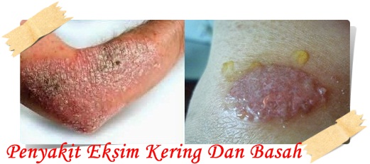 Obat Eksim Kering Dan Basah yang 100% TERBUKTI MANJUR !! Obat Eksim Kering Dan Basah yang 100% TERBUKTI MANJUR !!