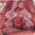 Diphtheria: Questions and Answers