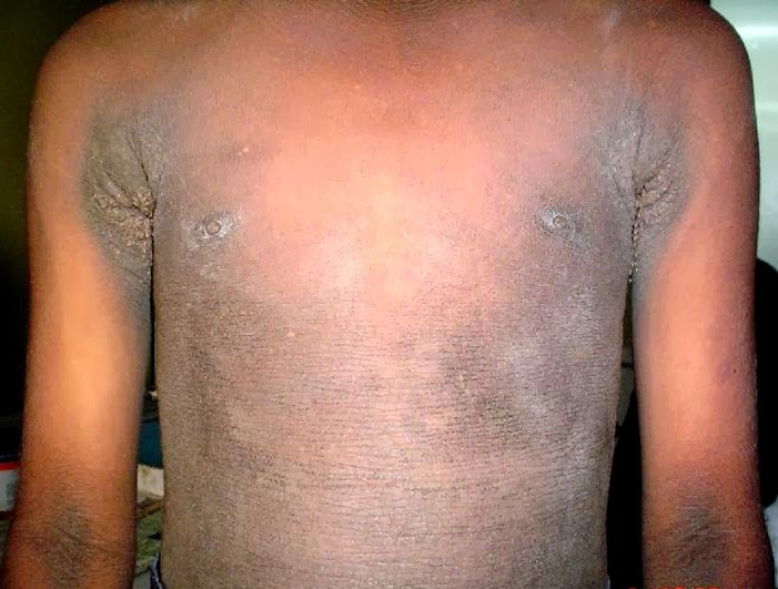 picture of acanthosis nigricans affected chest of a child