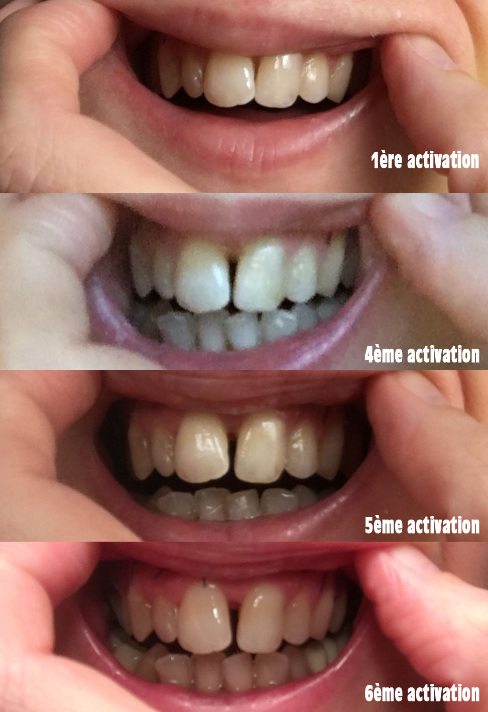 Dent Du Haut Qui S'écarte  - Perdre Ses Dents, Ce N�est Pas Une Fatalité.