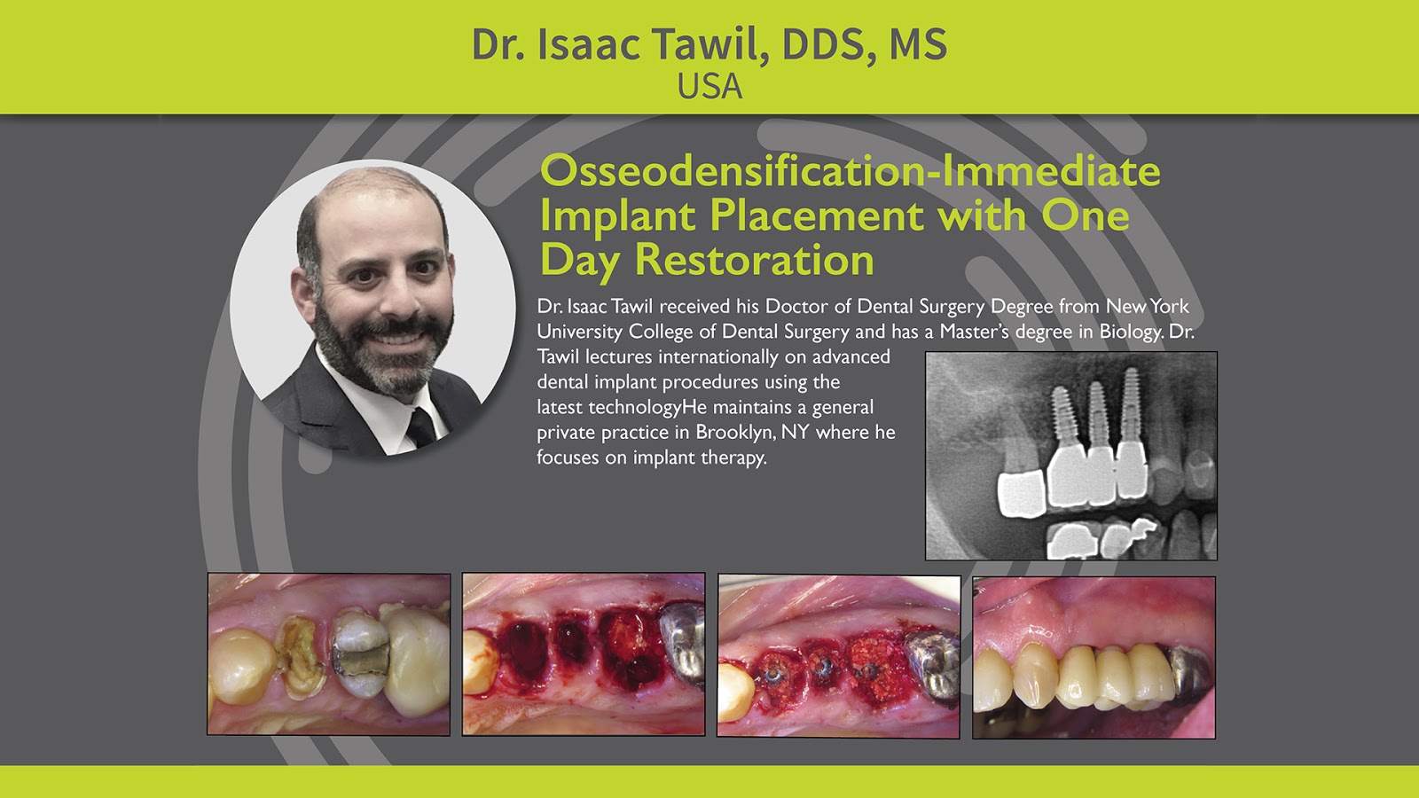 IMPLANTOLOGY Osseodensification Immediate Implant Placement with One
