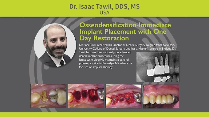 IMPLANTOLOGY: Osseodensification - Immediate Implant Placement with One Day Restoration - Dr. Isaac Tawil