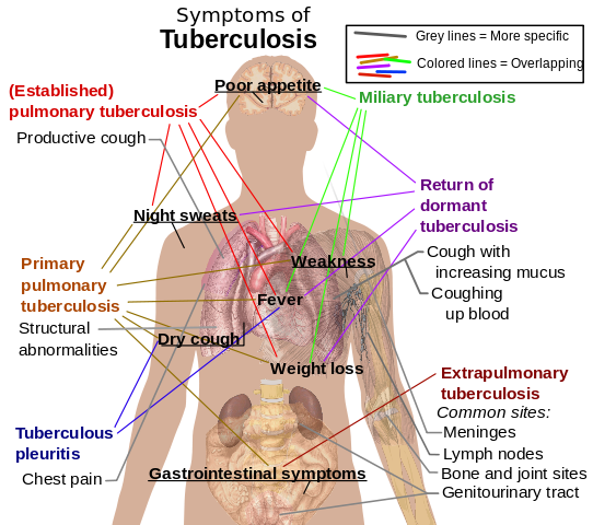 Tuberculosis infographic detailing symptoms