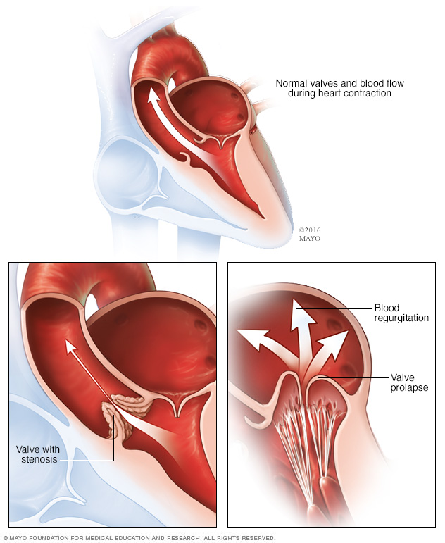 THE HEART VALVE DISEASE
