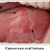 Be Aware Of This Early Signs Of Mouth Cancer Most People Ignores