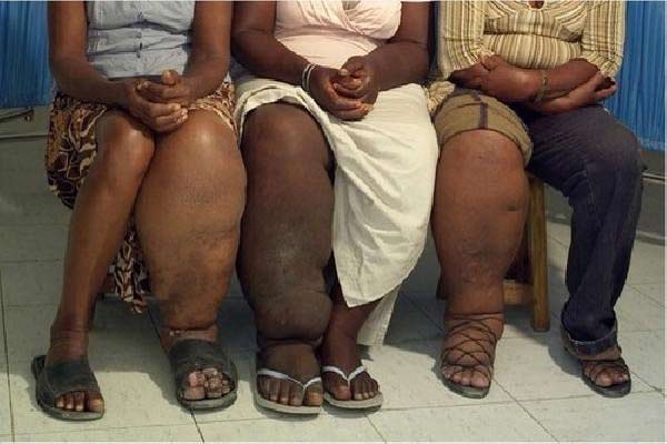 Cara Mencegah Penyakit Kaki Gajah dengan 4 Tips Ampuh - perpuskampus.com