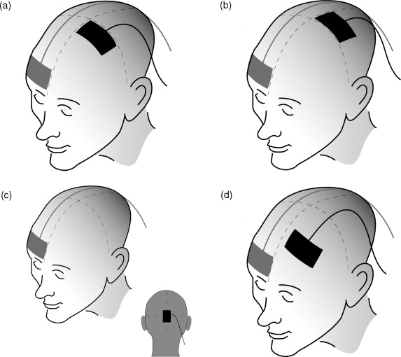 TDCSTranscranialDirectCurrent TDCs electrode positioning