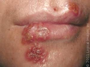 Tanaman herbal mengobati herpes tanaman herbal herpes , tumbuhan herbal untuk herpes , tumbuhan herbal obat herpes , tumbuhan herbal untuk penyakit herpes , tanaman herbal untuk herpes genital , tanaman herbal obat herpes