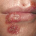 Tanaman herbal untuk penyakit herpes genital tipe 1 (HSV-1) dan tipe 2 (HSV-2) thumbnail