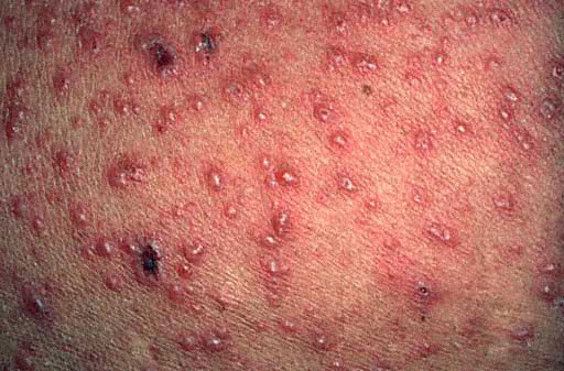 chicken pox adults picture #9