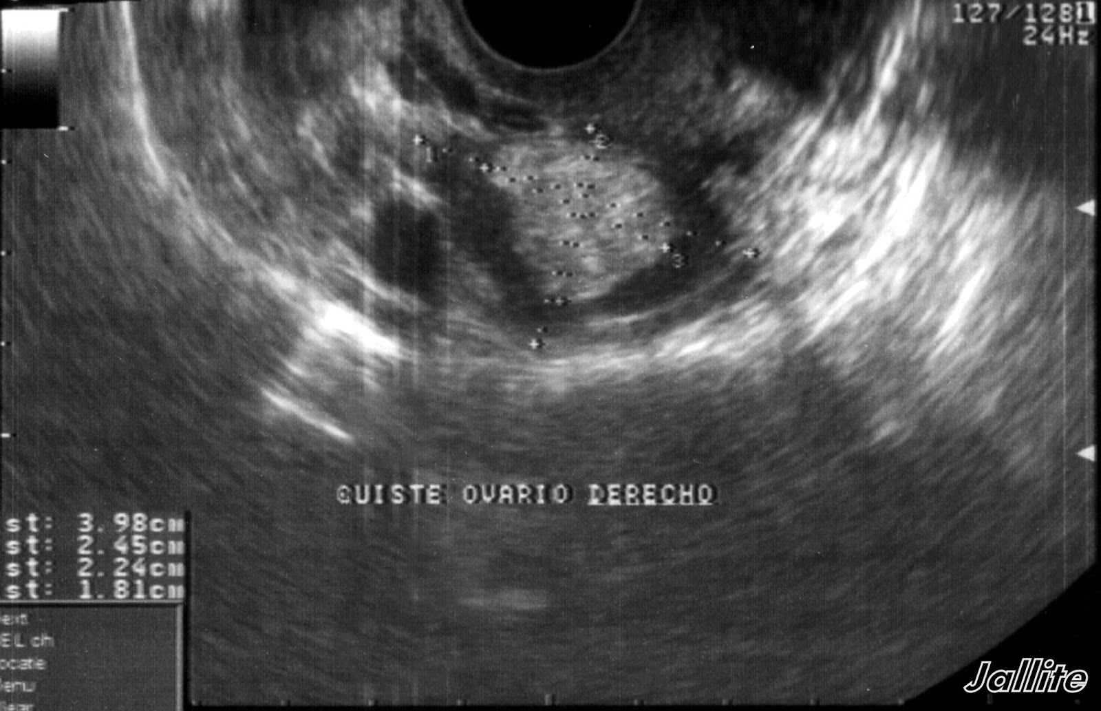 Teratoma Ovárico & Embarazo Teratoma Ovárico & Embarazo