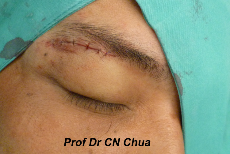 Eyelid Surgery by Prof Dr CN CHUA 蔡鐘能: Doc, I Got a Big Lump in My ...