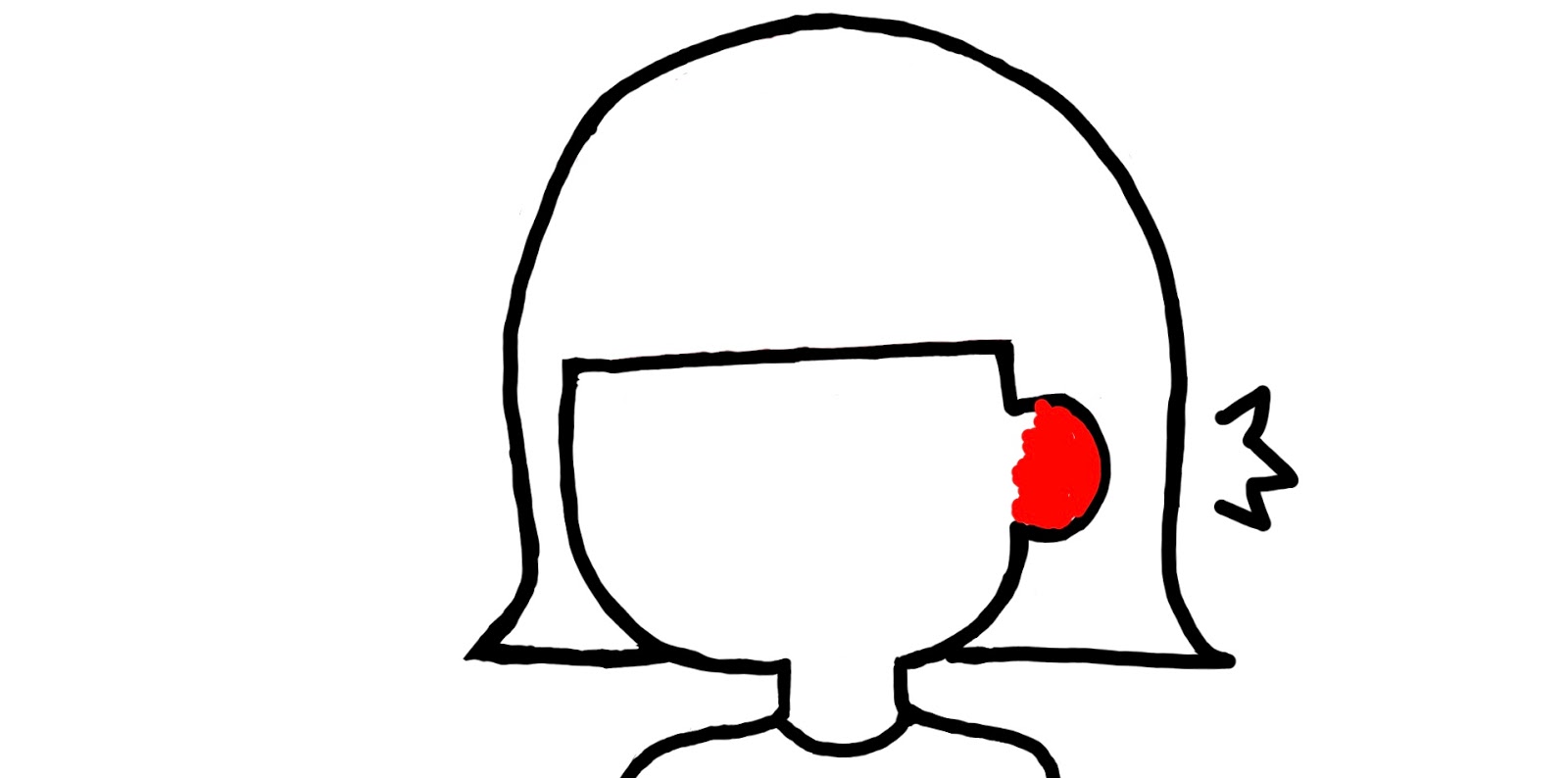 ピアスによるケロイドを手術で治療した体験談 びようどっと