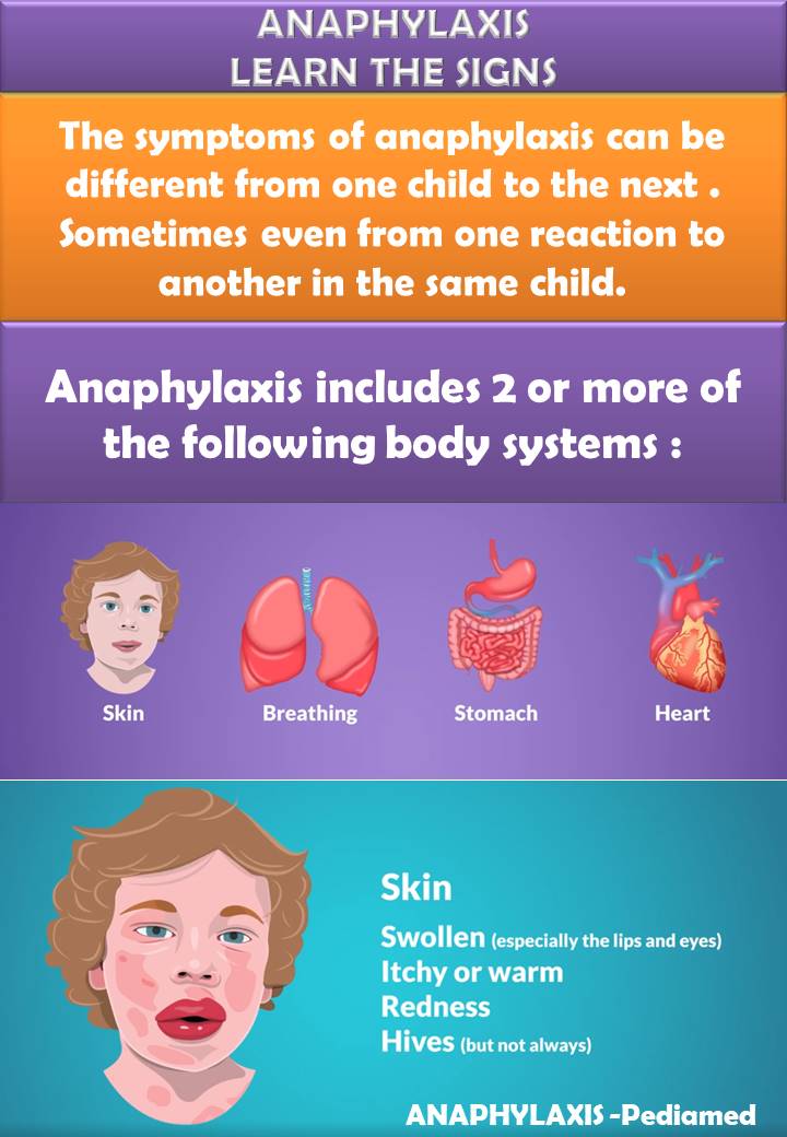 Pediamed What Is Anaphylaxis Learn The Signs And Symptoms In Children