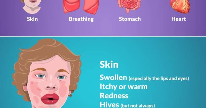 PEDIAMED: WHAT IS ANAPHYLAXIS ? LEARN THE SIGNS AND SYMPTOMS IN CHILDREN