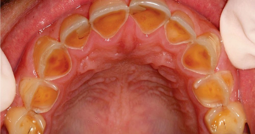 ¿ SABIAS QUE ? NOTICIAS y datos GENERAL EROSIÓN DENTAL Causas