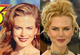 trendystyle: Nicole Kidman Plastic Surgery Before And After