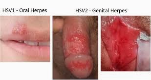 Una-guía-para-entender-el-Herpes