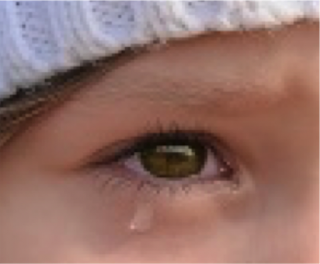 Baby tears due to duct occlusion