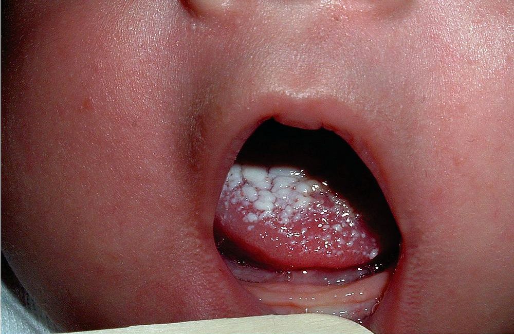 antimicotico candidiasis oral antimicotico candidiasis oral