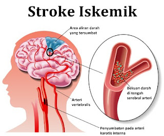 Manfaat Daun Karet Kebo Untuk Stroke gambar daun karet kebo, cara mengolah daun karet kebo, manfaat daun karet kebo bagi kesehatan, karet kebo untuk stroke, cara merebus daun karet kebo