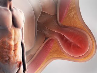 Obat Usus Turun Tradisional Obat Usus Turun