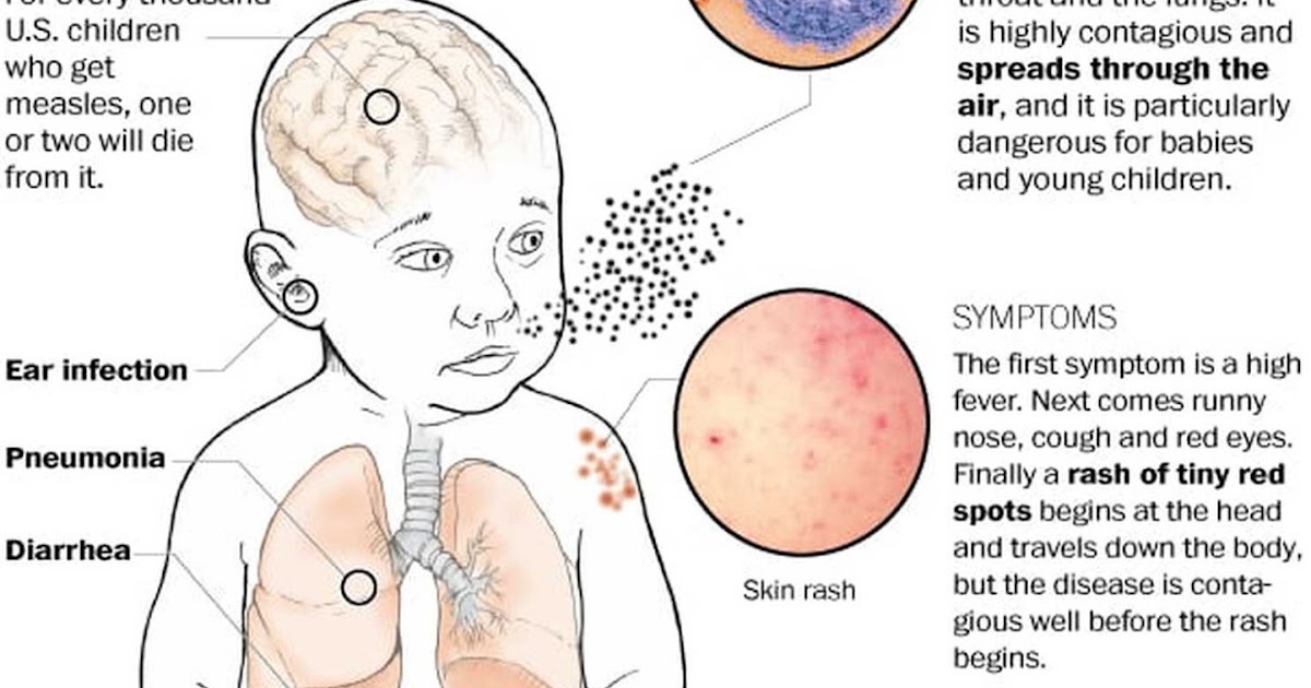 Measles Outbreak This Daycare Made A Terrible Mistake - 3oykotc
