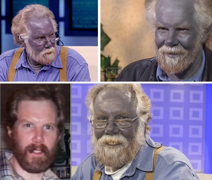 the inbred appalachian family with blue skin the collective