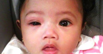 Penyebab dan Cara Menangani Mata Merah Pada Bayi Penyebab dan Cara Menangani Mata Merah Pada Bayi