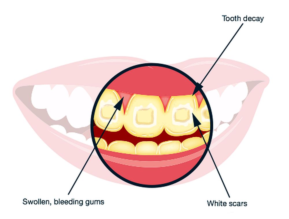 ORTHODONTICS Risks of Dental Braces Directorio Odontológico