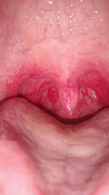 Obat Radang Tenggorokan