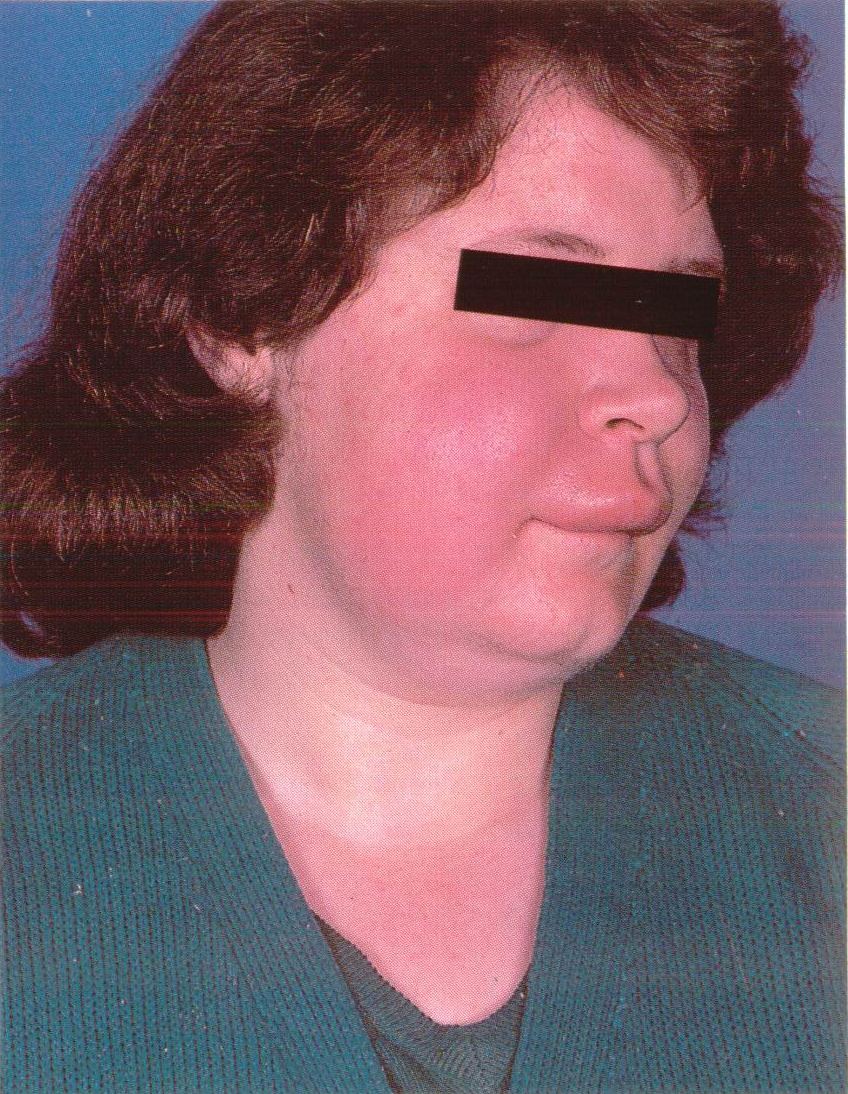 Dentistry lectures for MFDS/MJDF/NBDE/ORE Lip lesions, Oral medicine