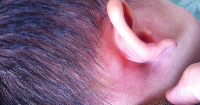Ada benjolan di belakang telinga si kecil? Berbahayakah? ~ Never ending