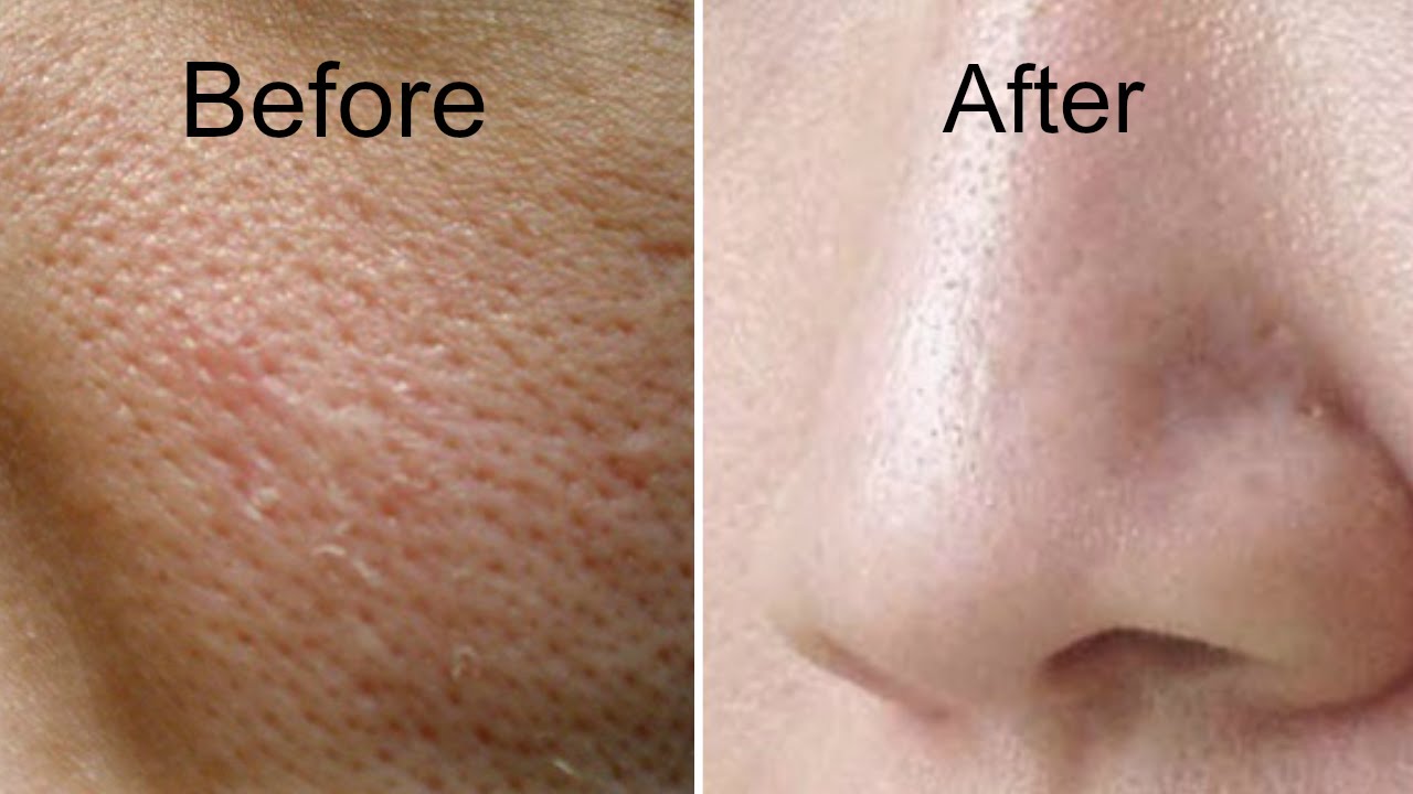 Skin Remedies For Large Pores Get Rid Of Large Pores Open Pores